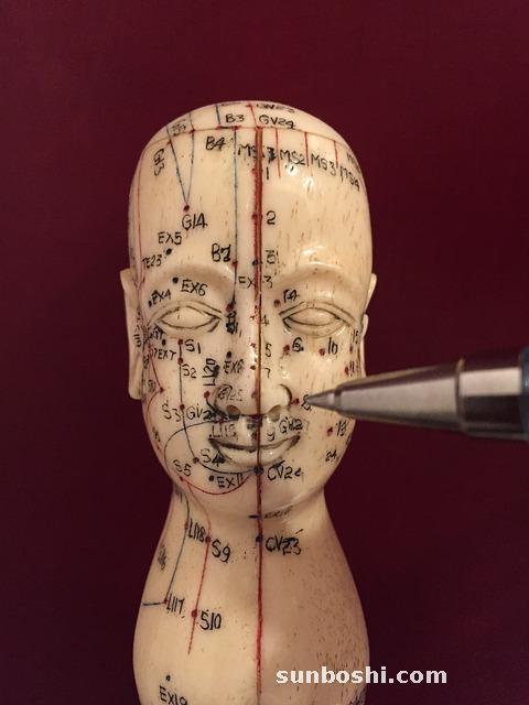 針灸的功效與作用-溫針灸-針灸合谷-陰陽針灸-針灸額頭